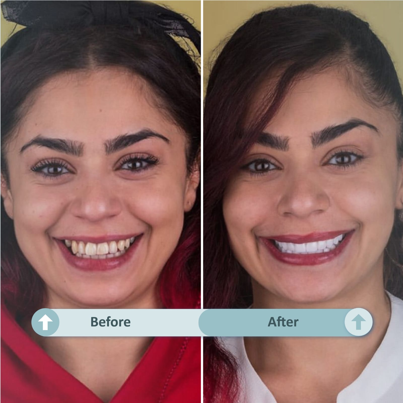 Kadın saç ekimi öncesi - ayrım çizgisi seyrekliği