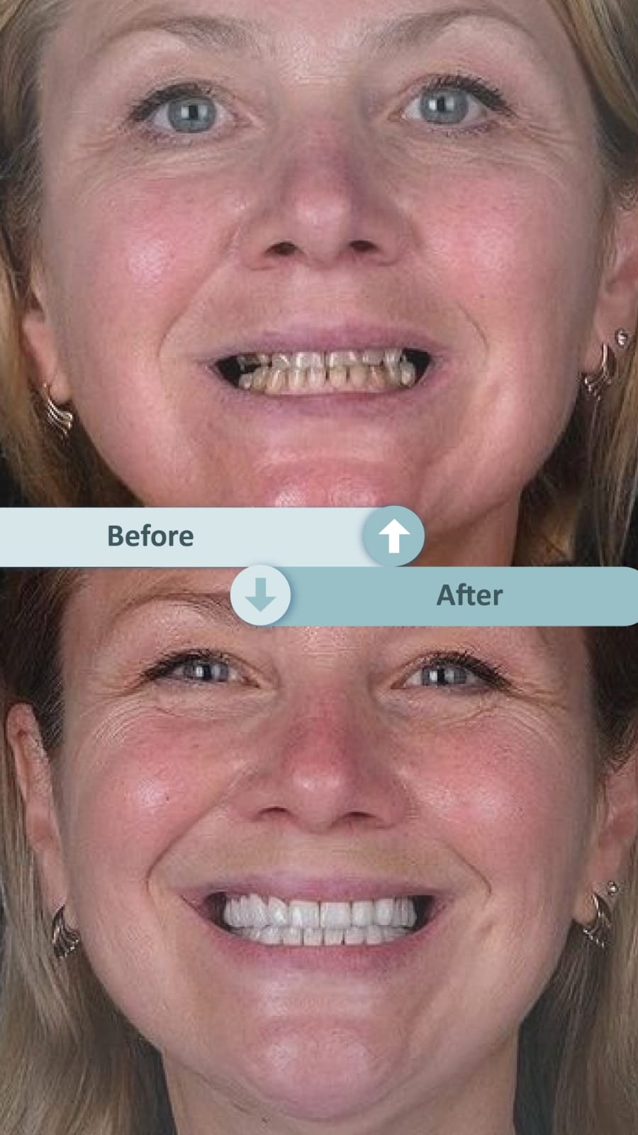 Diş estetiği uygulaması sonrası gülümseyen hasta